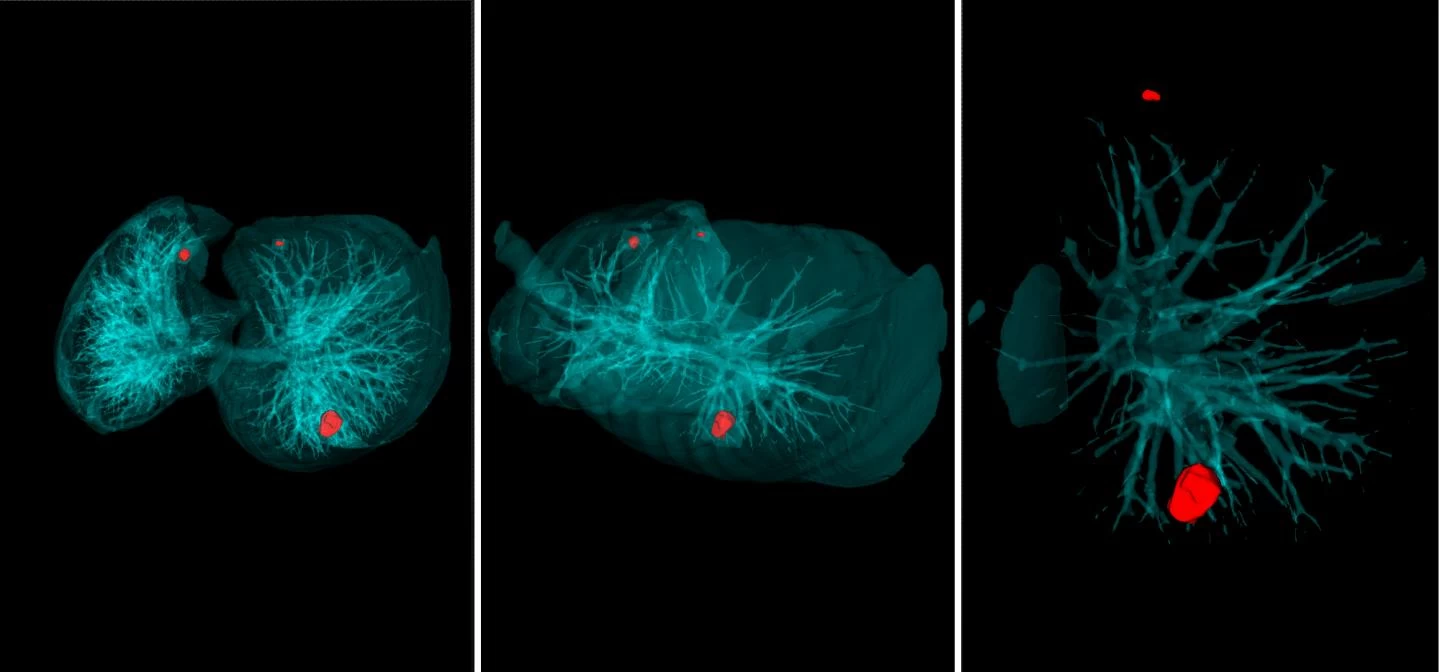 Καρκίνος του πνεύμονα: Δεν κινδυνεύουν μόνο οι καπνιστές!